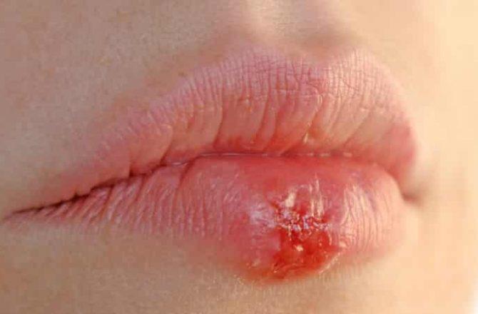 Аллергические высыпания на губах
