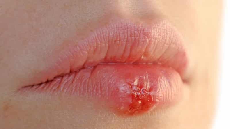 Аллергические высыпания на губах