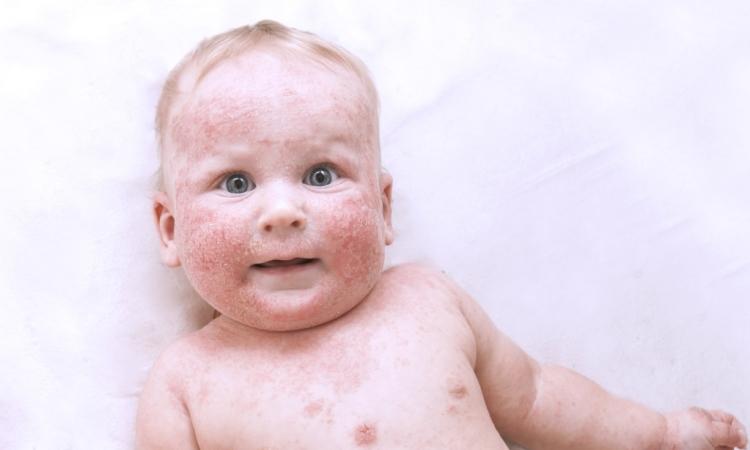 Аллергия на молоко у детей