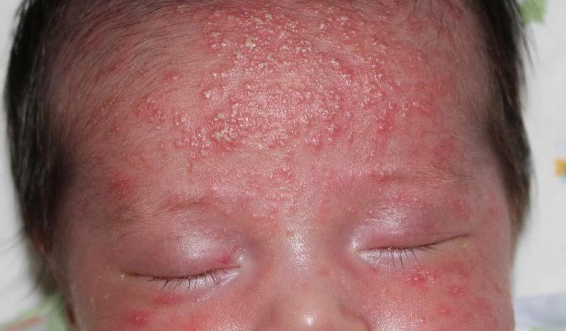 Аллергия у ребенка на сладкое