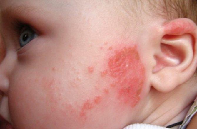Красные точки на коже при аллергии