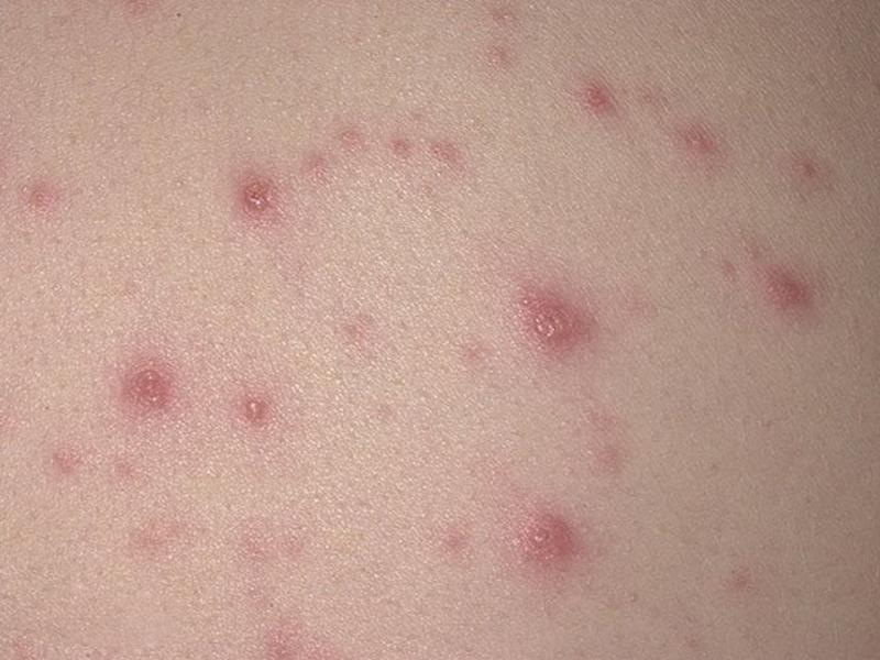 красные точки на коже лечение