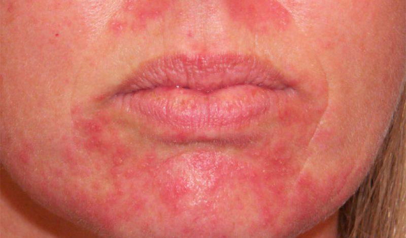 Аллергические пятна на коже