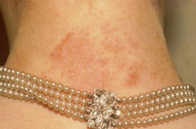 Как проявляется аллергия на металлы на коже?
