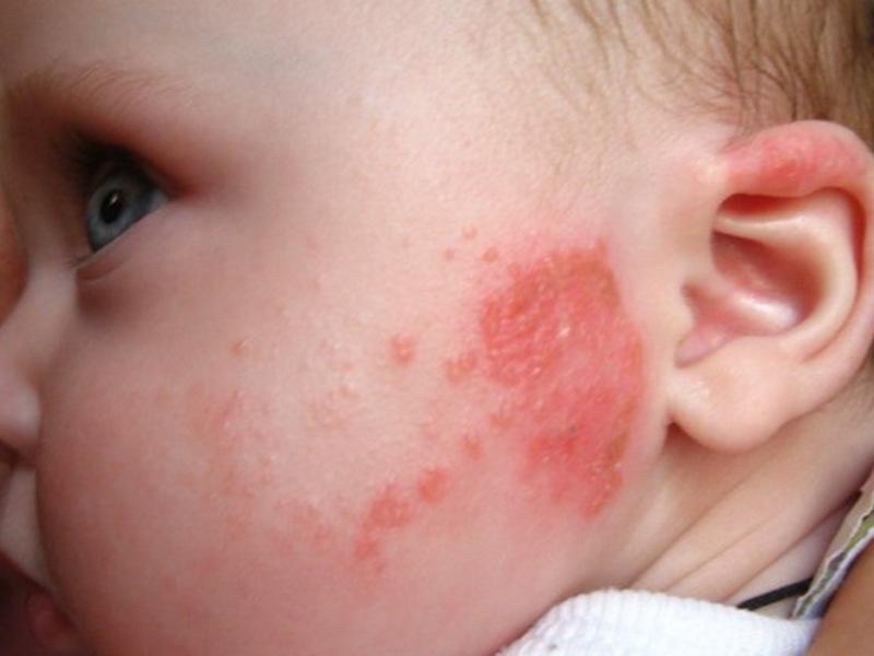 Лечение аллергии перепелиными яйцами у детей thumbnail
