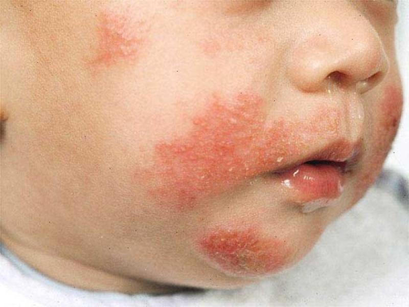 Декстроза может ли быть аллергия thumbnail